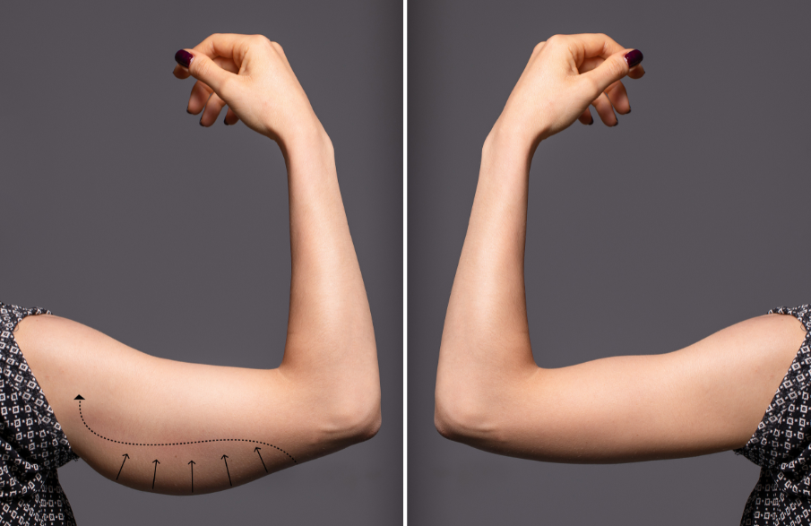 Transform Your Arms with Brachioplasty: Regain Confidence in Dallas